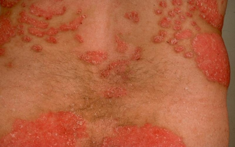 Dangerous Skin Diseases