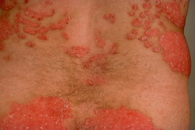 Dangerous Skin Diseases