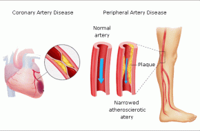 Peripheral Arterial Diseases