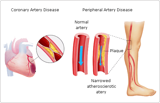 Peripheral Arterial Diseases