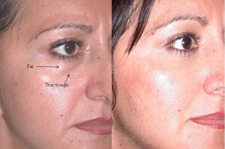 Lower Eyelid Surgery
