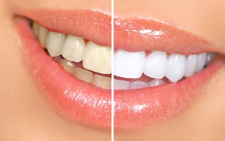 Professional vs Over The Counter Teeth Whitening