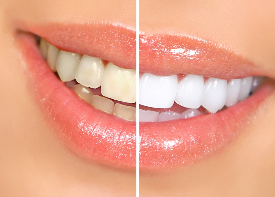 Professional vs Over The Counter Teeth Whitening