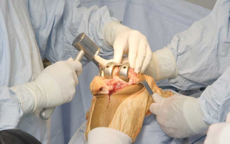 Guide To A Knee Replacement Surgery
