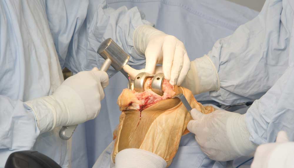 Guide To A Knee Replacement Surgery
