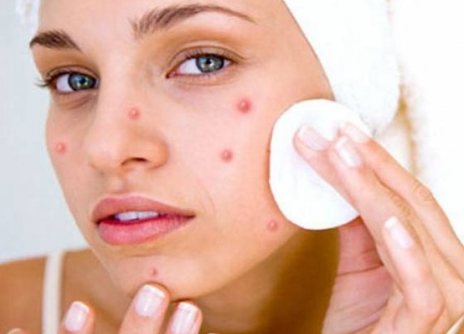 Treating Facial Infections With The Popular Antifungal Creams and Solutions