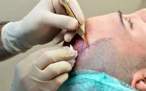 hair transplant in Jalandhar Punjab