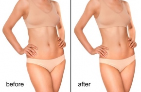 Liposuction in Ludhiana