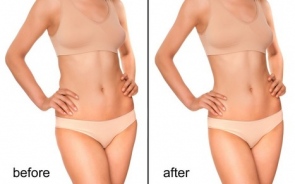 Liposuction in Ludhiana