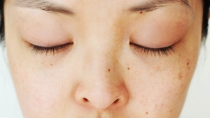 6 Dermatologist Approved Dark Spot Treatments