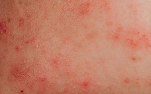 What Triggers Eczema and How To Avoid It?