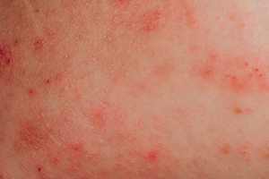 What Triggers Eczema and How To Avoid It?